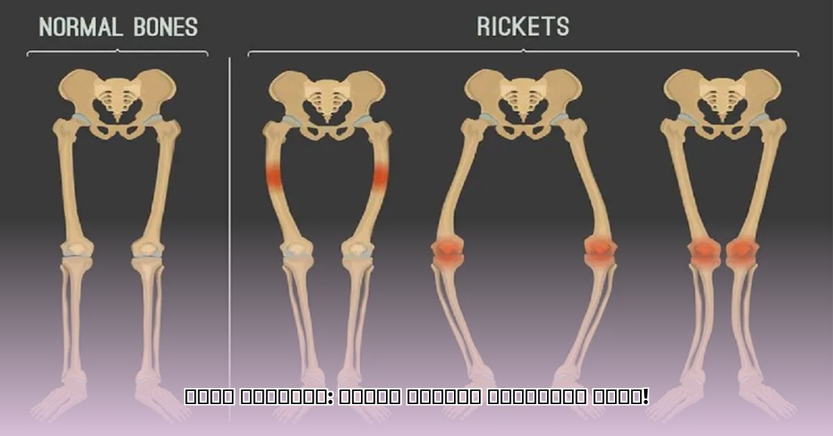 rickets-in-children